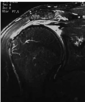 Figure 1 – t2 magnetic resonance image of right shoulder in  coronal slice, showing large lesion in the supraspinatus tendon.