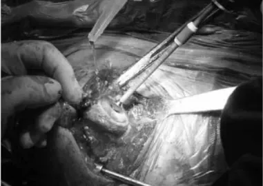 Figure 1 –  Degenerative pathological condition in the proximal  humerus seen after dislocation maneuver.