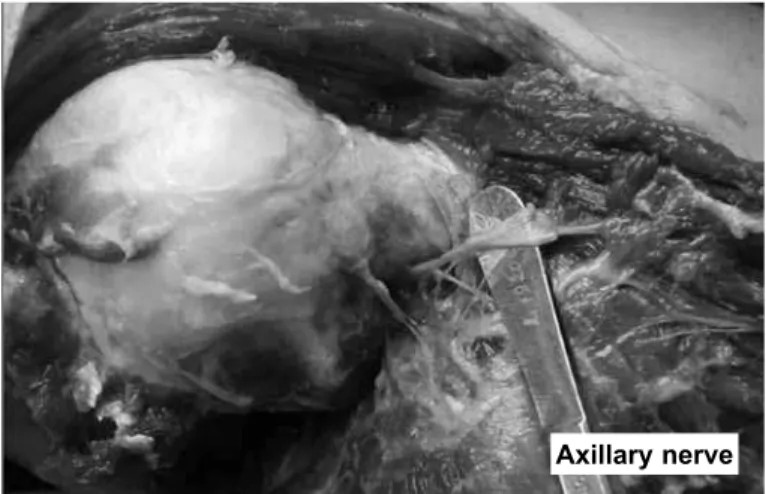Figure 2 –  Deltoid muscle deinserted from the acromion and cla - -vicle, and pulled back laterally; axillary nerve dissected starting  from its emergence through the quadrangular space.