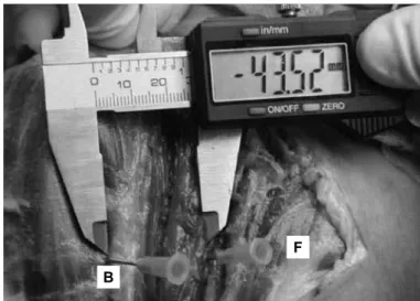 Figure  5  –  Mark-up  of  the  lateral  margin  of  the  acromion: 
