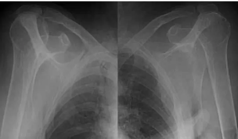 Figure  2  –  X-ray  images:  bilateral  anterior  dislocation  of  the  shoulders after reduction.