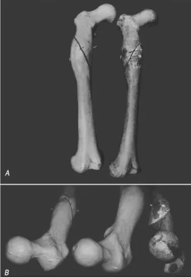 Figure 4 –  Two plastic models with the same deformity as in the  model of figure 2. In (A): cuts with obliquity of 65° were made  in both models, but in opposite directions; this corrected the  an-gular  deformity