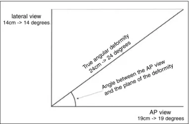 Figure 5 –  Example of estimation of the true angular deformity  and the position of the plane of the deformity, using the rectangle  rule