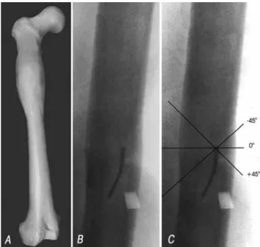 Table 1 was developed to answer the question of  whether the osteotomy should be performed with its  obliquity inclined in the clockwise or anticlockwise  direction