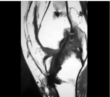 Figure 6 –  Good state of neoalignment shown through magnetic  resonance, in the fifth month postoperative.