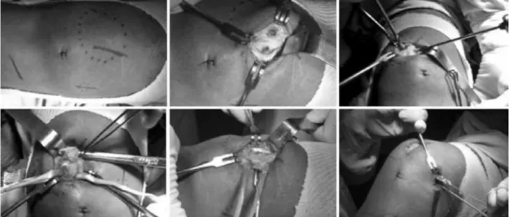 Figure 1 –  Technique: preparation of the tunnels through which the graft is passed.