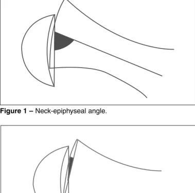 Figure 2 –  Epimetaphyseal angle.
