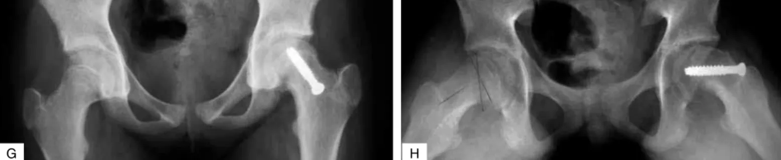 Figure 3 –  g, h) Onset of symptoms in R hip and postoperative L hip (seven months) in May/07.