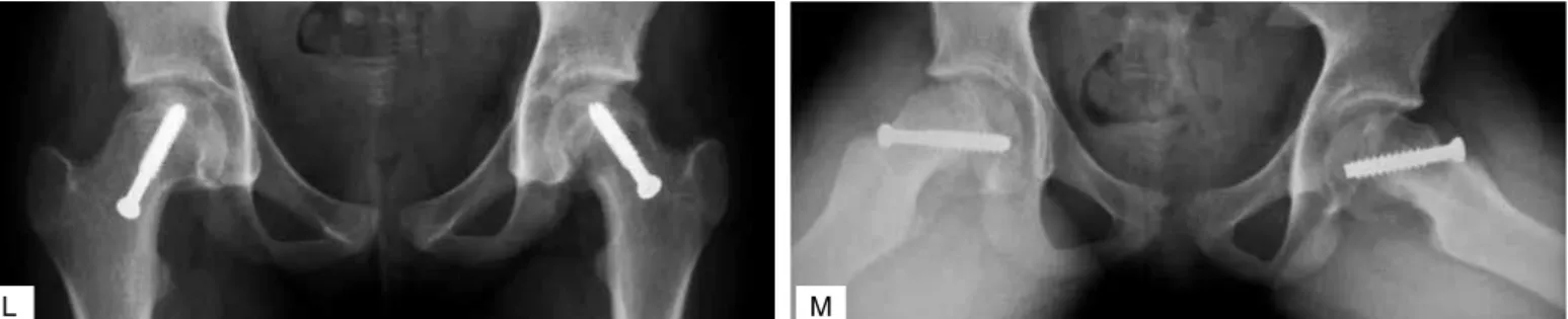 Figure 3 –  l, m) Postoperative L hip (two months) and R hip (10 months) in Aug/07.