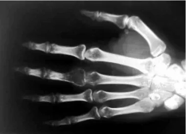 Figure 1 –  Hypertransparency in the proximal phalanx of the  third finger.