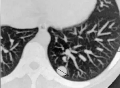 Figure  4  –  Microscopy of the giant cell tumor affecting the  proximal phalanx.