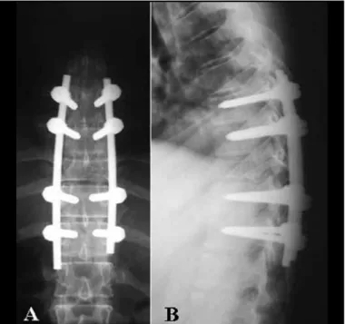 Figure 1 –  Radiographic incidences in AP (A) and profile (B)  showing fracture of vertebra T9 (black arrows)