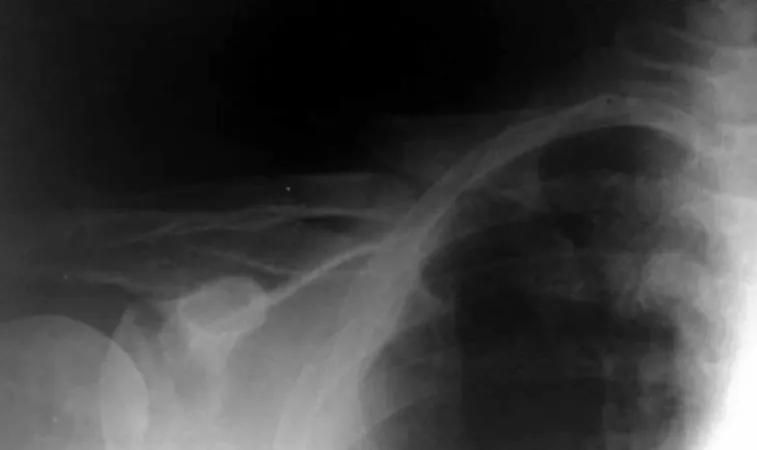 Figure 1 –  Fracture of the clavicle following trauma.