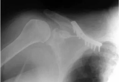 Figure 5 –  Postoperative view showing decrease in edema of  the upper right limb.