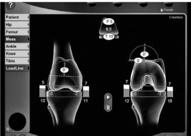 Figure 3 – Surgeon inputting to the system the anatomical reference  point indicated on the monitor, using a pointer coupled to a rigid body.