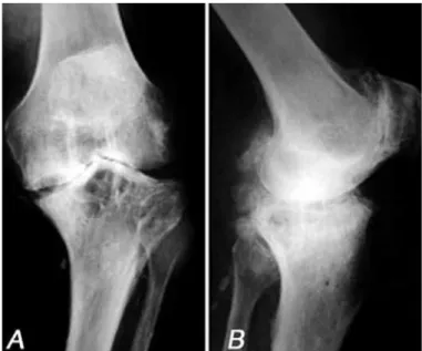 Figure 1 –  Radiographic appearance of a patient with severe  genu varus who underwent the proposed technique.