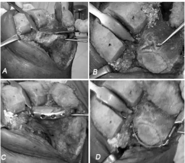 Figure 2 –  Sequence for preparation of the receptor area. A)  Appearance of the defect before it was filled in; B) Defect viewed  from above, after making the lateral edge of the defect vertical; C  and D) After adaptation of the graft and placement of th