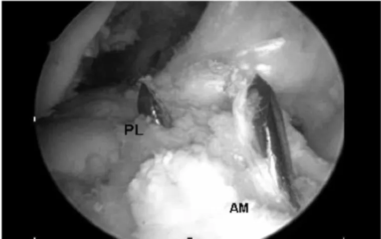Figure 1 – Intraoperative view of the guidewires on the tibial  joint surface.