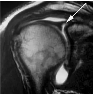 Figure 2 – Arthroscopic image of the right shoulder (posterior  view), showing deinsertion of the superior glenoid labrum (A) and  after suturing of the lesion (B).