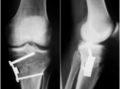 Figure 1 – Medial open wedge osteotomy fixed with Puddu plate.