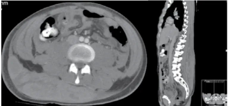 Figure 1 – Radiograph of the pelvis and axial computed tomo- tomo-graphy – images of pelvic fractures.