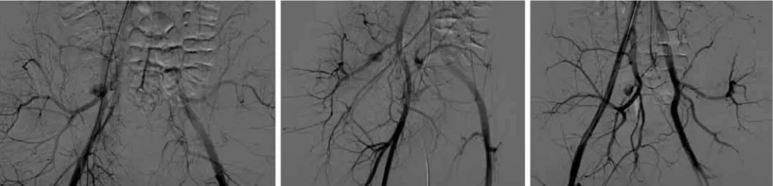Figure 3 – Images of the first angiography performed. Adjacent to the internal iliac artery, an image of a sac measuring 37 mm, with con- con-trast medium inside it (caliber of 21 mm), thus suggesting the presence of a pseudoaneurysm in a branch of the rig