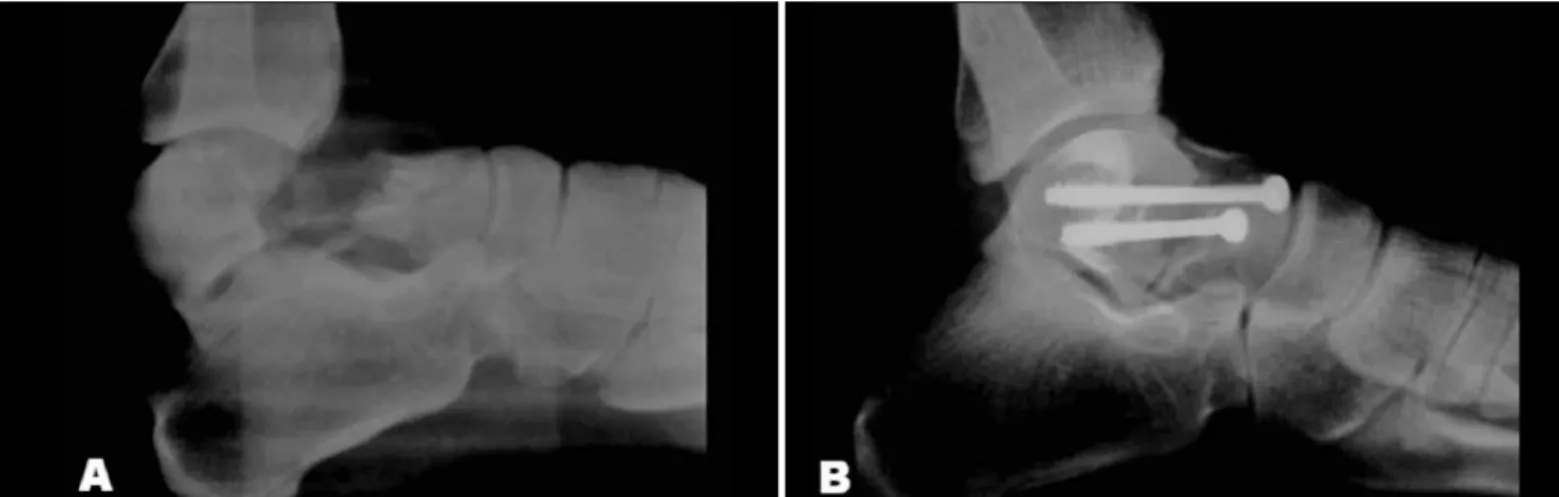 Figure 1 – A) Initial fracture of the talar neck, of Hawkins type II;  B) Control in immediate postoperative period.