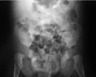 Figure 3 – Preoperative radiograph on patient with bladder exs- exs-trophy, showing pubic diastasis of 4.2 cm.