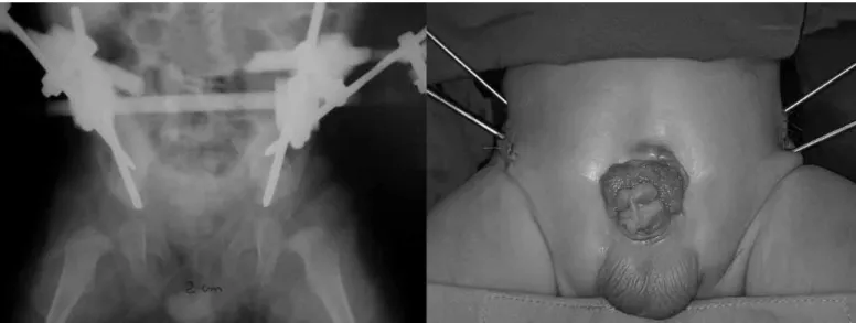 Figure 4 – A) Left: patient at the end of the orthopedic procedure, released to undergo bladder closure