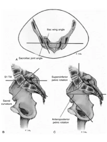 Figure 10 – Increase of 10º in the angle of the sacroiliac joint  and 15º in internal rotation of the pelvis.