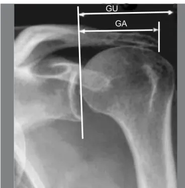 Figure 4 – Relationship between the angle of lateral tilt of the acromion and  rotator cuff injury in MRI (9) .