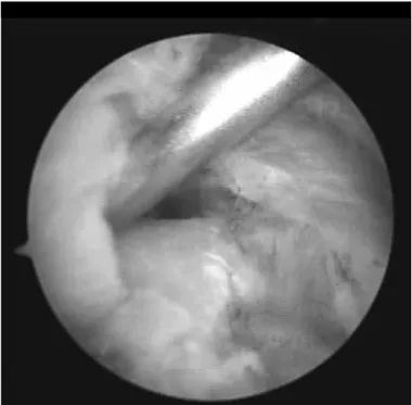 Figure  4  –  Needle  positioned  between  the  repaired  tendon  and  the  bone bed.