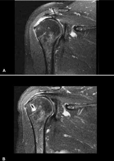 Figure 6 – MR image. (A) Preoperatively, with complete rupture of the  supraspinatus. (B) Postoperatively, with no evidence of rerupture  (inter-position of fluid between the tendon and bone is not observed).