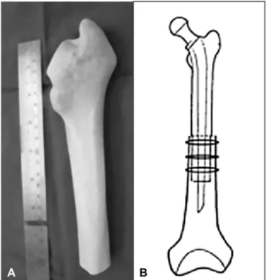 Figure 2 – (A) Patient, 26 years old, with juvenile rheumatoid arthritis with  multiple previous surgeries