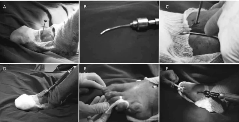 Figure 1 – Antegrade surgical technique. (A) Acute surgical drill introduced percutaneously 10 mm from the base of the fractured metatarsal