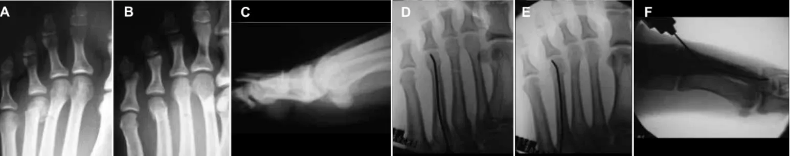 Figure 3 – Radiological demonstration of the percutaneous antegrade treatment. (A) Fracture of the neck of the fourth metatarsal with deviation greater than 3 mm  in the frontal plane