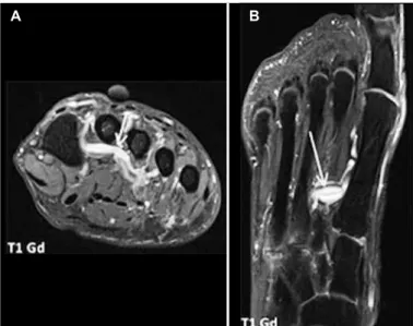 Figure 1 – Female patient, 40 years. Coronal T2WI FSE with fat saturation  (A) – Edema in the myoadipose planes, around the plantar metatarsal vein  between metatarsals II and III of the right forefoot