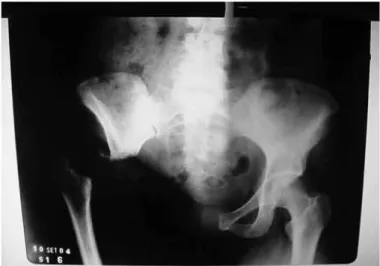 Figure 4 – X-ray of a patient previously submitted to right internal hemi- hemi-pelvectomy