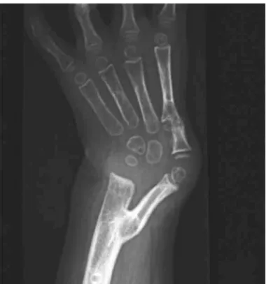 Table 2 – Modified Bayne and Klug classification for radial club hand.