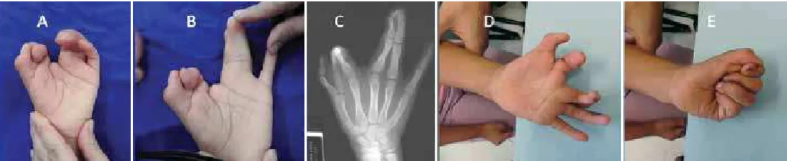 Figure 10 – Typical cleft hand (A, B and C); after the operation and functional result (D and E).