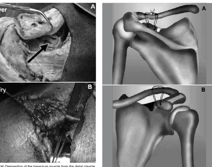 Figure 1 – (A) Deinsertion of the trapezium muscle from the distal clavicle,  which was subsequently pushed away so that the top of the base of the  coracoid process (arrow) could be viewed, in a cadaver