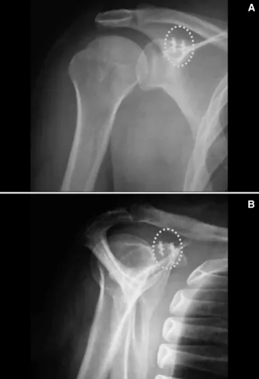 Figure 3 – Postoperative radiograph of the shoulder in anteroposterior view  (A) and lateral view (B), demonstrating the anchors in the coracoid process  and the reduction of the acromioclavicular joint.
