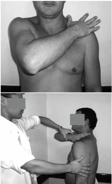 Figure 1 – Bear hug semiological maneuver as described by Barth et al (13) .  The patient is placed in an upright standing position
