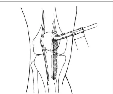 Figure 1 – Resection of the middle third of the patellar ligament going  towards the medial edge of the patella, between the middle and proximal  thirds (reproduced with permission from Camanho et al) (16) .