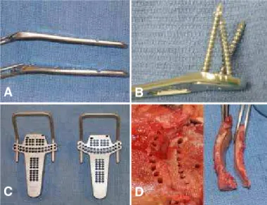 Figure 1 - Two plate flare angles shown in (A) and (B) showing the varied  fixed angle constraint of the distal screw-plate interface