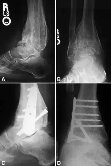 Figure 3 - 61 year old male patient presented with post-traumatic tibio- tibio--talar arthritis with pain and deformity