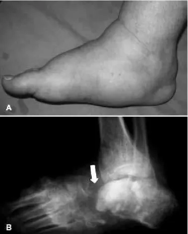 Figure 1 – Profile of the right foot showing diffuse edema and collapse of  the medial plantar arch (4A)
