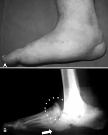 Figure 3 – Profile of the right foot of the same patient as in Figures 1 and 2  after completing the treatment with TCC, showing the plantigrade position of  the foot, now without detectable edema but with marked collapse of the  me-dial arch (6A)