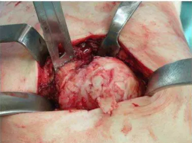Figure 1 – Joint exposure of the left hip showing high degree of compro- compro-mising of the femoral head.