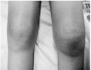 Figure 1 – Bilateral hemarthrosis of the knee. 